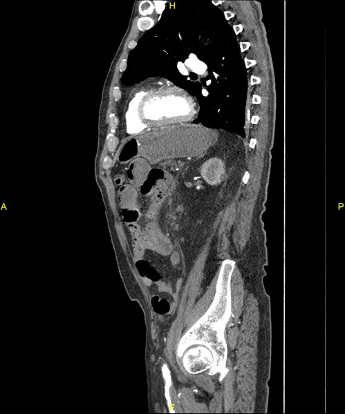 File:Aortoenteric fistula (Radiopaedia 84308-99603 C 234).jpg