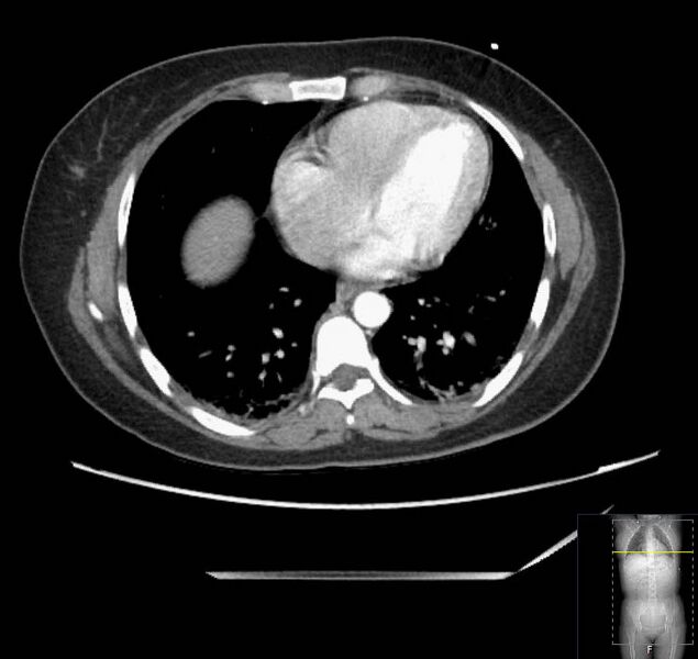File:Appendicitis (CT angiogram) (Radiopaedia 154713-127660 Axial 185).jpg