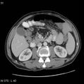 Appendicitis (Radiopaedia 27446-27642 A 13).jpg