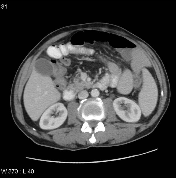 File:Appendicitis (Radiopaedia 27446-27642 A 13).jpg