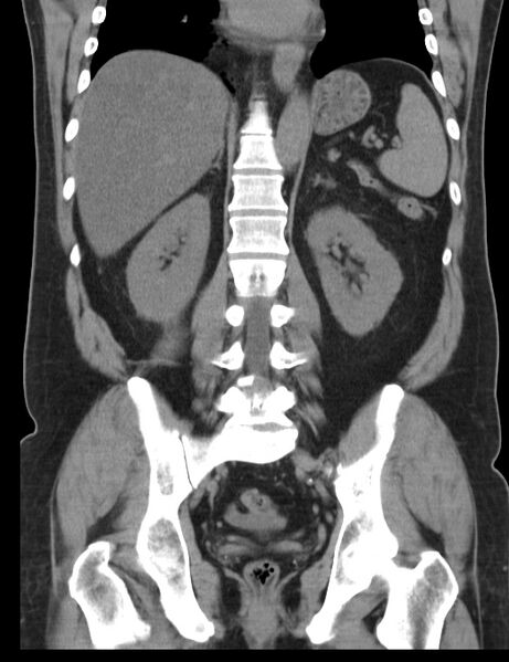File:Appendicitis and giant appendicolith (Radiopaedia 80251-93588 Coronal non-contrast 31).jpg