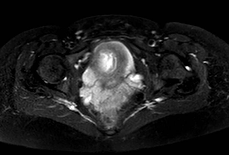 File:Appendicitis in gravida (MRI) (Radiopaedia 89433-106395 Axial T2 SPAIR 72).jpg