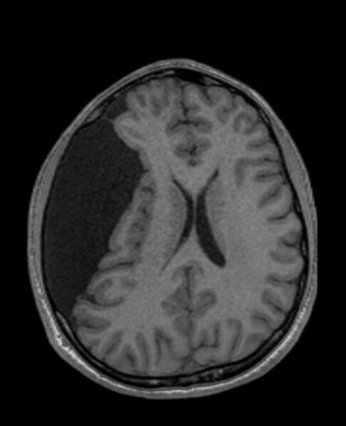 File:Arachnoid cyst- extremely large (Radiopaedia 68741-78451 Axial T1 48).jpg