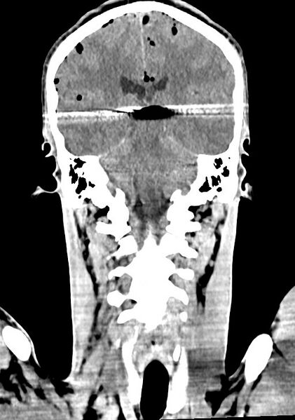 File:Arrow injury to the brain (Radiopaedia 72101-82607 Coronal non-contrast 47).jpg