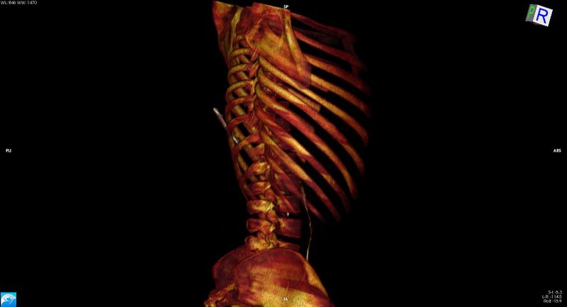 File:Arrow injury to the chest (Radiopaedia 75223-86321 3D bone 30).jpg