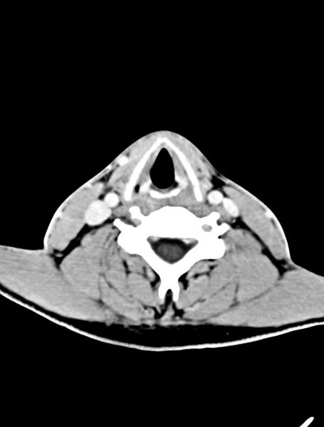 File:Arrow injury to the face (Radiopaedia 73267-84011 Axial C+ delayed 5).jpg