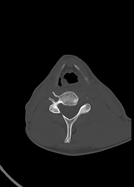 File:Arrow injury to the head (Radiopaedia 75266-86388 Axial bone window 3).jpg