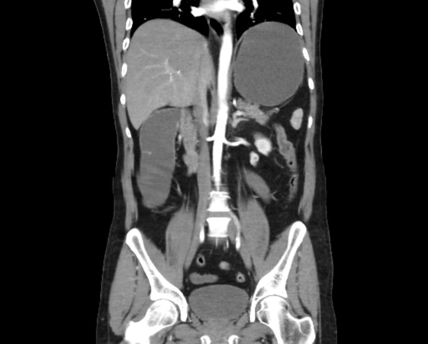 Arterial occlusive mesenteric ischemia (Radiopaedia 84641-100060 B 31).jpg