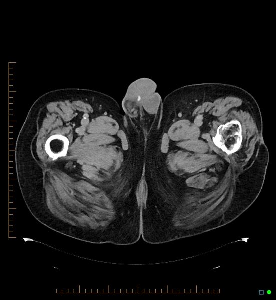 File:Artificial urethral sphincter (Radiopaedia 46937-51464 A 17).jpg