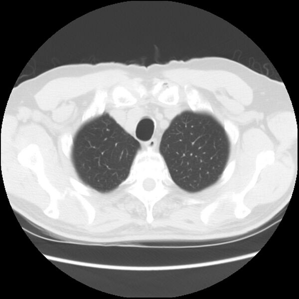 File:Asbestos-related pleural plaques (Radiopaedia 39069-41255 Axial lung window 10).jpg