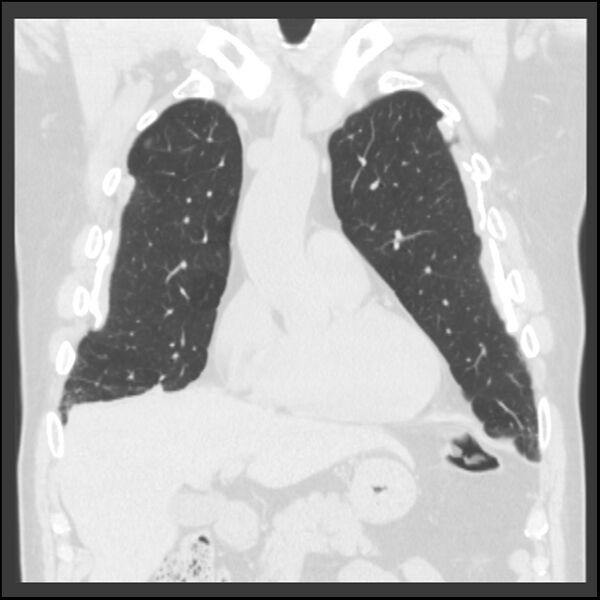 File:Asbestos-related pleural plaques (Radiopaedia 39069-41255 Coronal lung window 63).jpg
