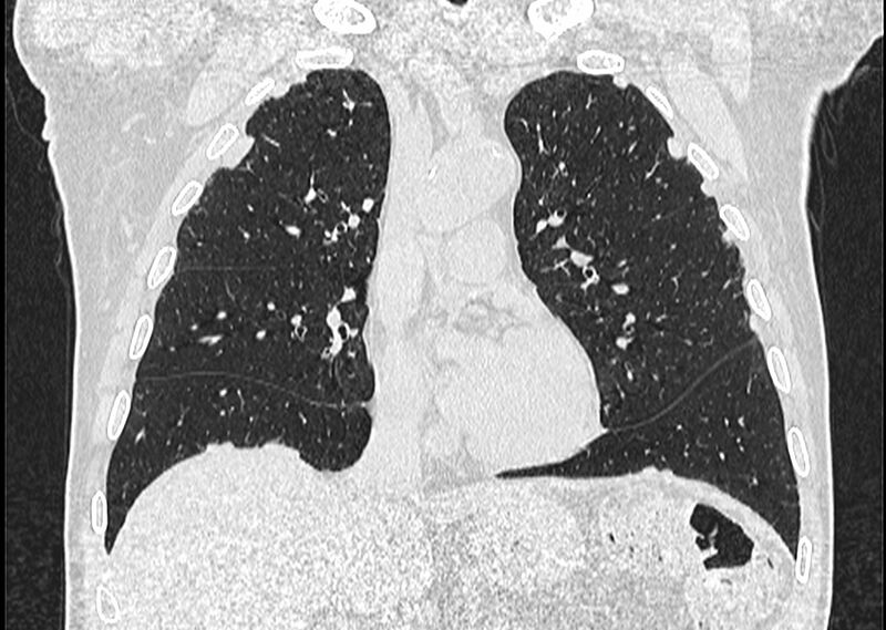File:Asbestos pleural placques (Radiopaedia 57905-64872 Coronal lung window 118).jpg