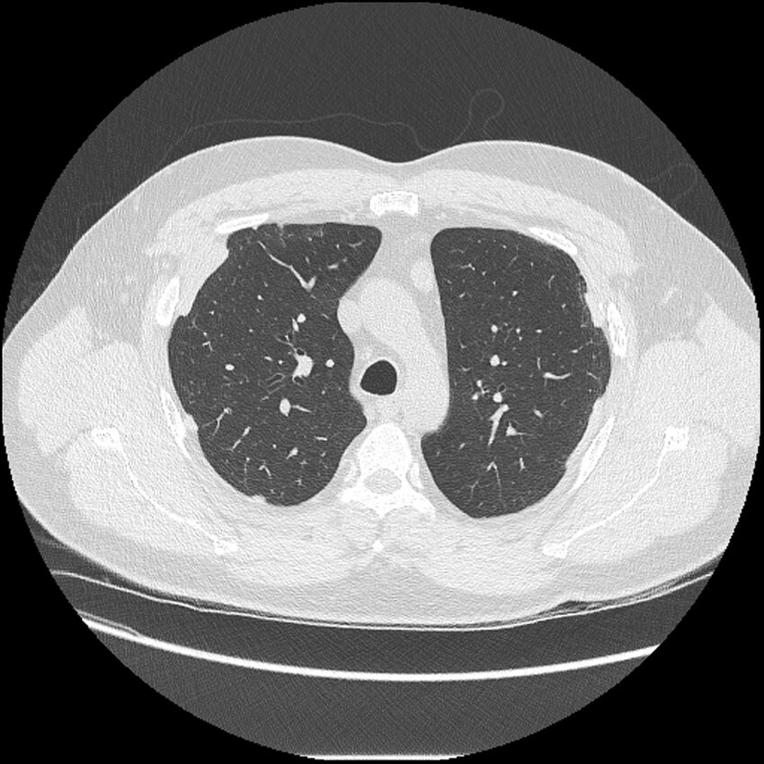 Asbestosis (Radiopaedia 45002-48961 Axial lung window 16).jpg