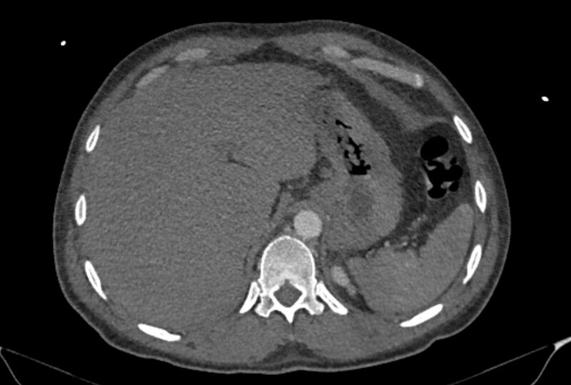 File:Ascending aortic aneurysm (Radiopaedia 86279-102297 C 63).jpg