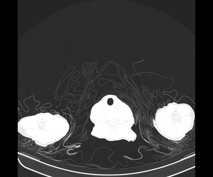 File:Aspergillomas (Radiopaedia 66779-76110 Axial lung window 2).jpg