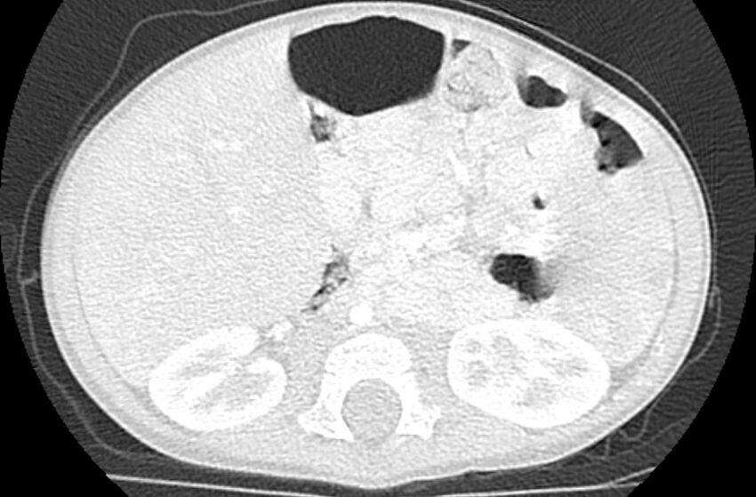 Asplenia syndrome (Radiopaedia 73083-83792 Axial lung window 94).jpg