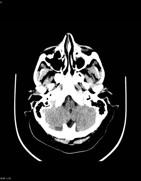 File:Astroblastoma (Radiopaedia 39792-42216 Axial non-contrast 7).jpg