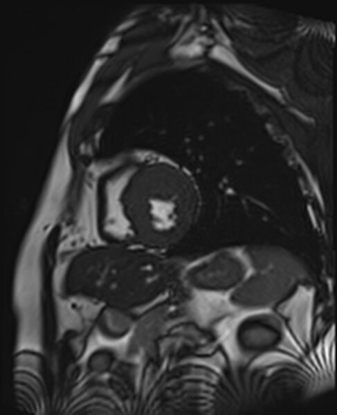File:Asymmetric septal hypertrophic cardiomyopathy - systolic anterior motion of mitral leaflet (Radiopaedia 72795-83445 C 18).jpg