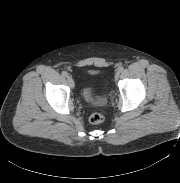 File:Atrophic kidney due to severe chronic obstructive hydronephrosis (Radiopaedia 40828-43474 Axial non-contrast 44).jpg