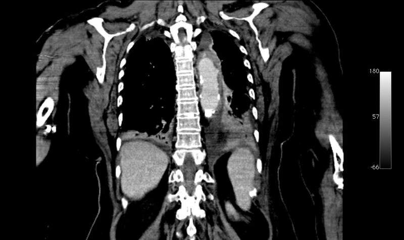 File:Atypical dissection of the thoracic aorta (Radiopaedia 10975-78320 B 37).jpg