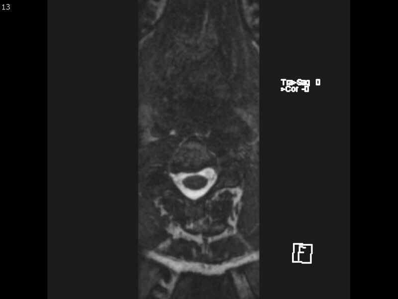 File:Atypical meningioma - intraosseous (Radiopaedia 64915-74572 Axial CISS 13).jpg
