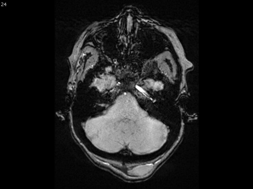Atypical meningioma - intraosseous (Radiopaedia 64915-74572 Axial SWI 24).jpg