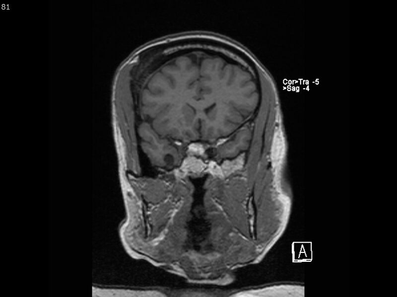 File:Atypical meningioma - intraosseous (Radiopaedia 64915-74572 Coronal T1 81).jpg