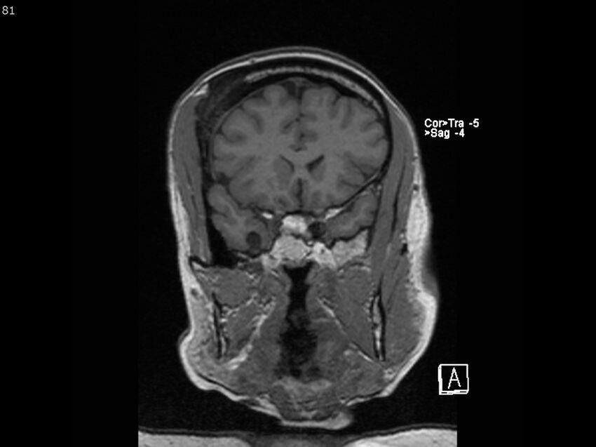 Atypical meningioma - intraosseous (Radiopaedia 64915-74572 Coronal T1 81).jpg