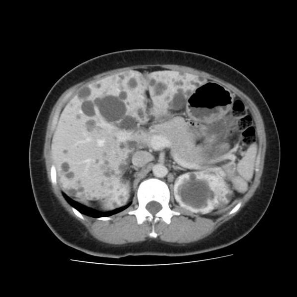 File:Autosomal dominant polycystic kidney disease (Radiopaedia 23061-23093 C 20).jpg