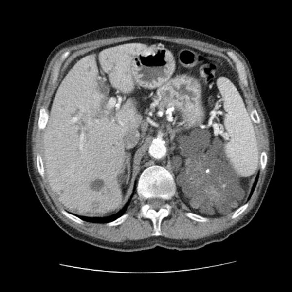 File:Autosomal dominant polycystic kidney disease (Radiopaedia 27851-28094 B 59).jpg