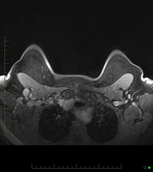 File:Axillary lymphadenopathy on breast MRI- yellow fever vaccination induced (Radiopaedia 19454-19483 Axial T1 C+ fat sat 12).jpg