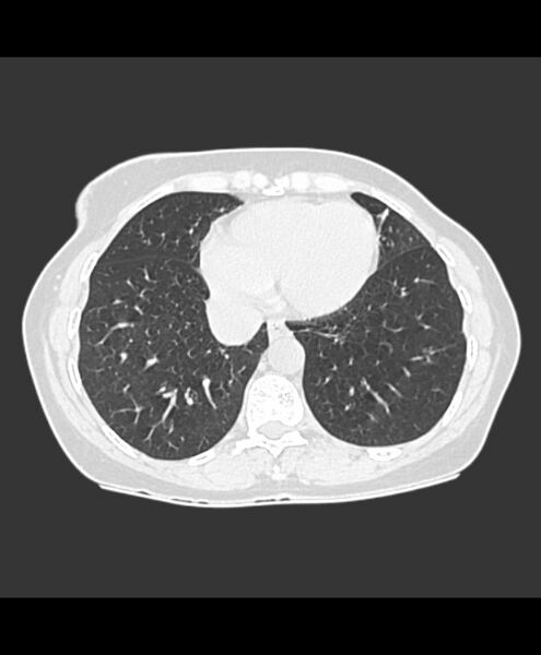 File:Azygos fissure and azygos lobe (Radiopaedia 41841-44832 Axial lung window 3).jpg