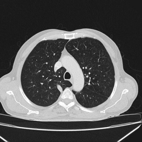 File:Azygos lobe (Radiopaedia 38259-40275 Axial lung window 24).jpg