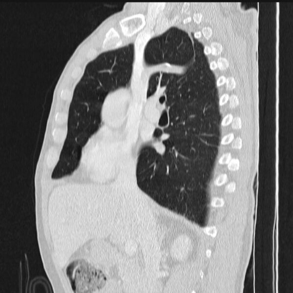 File:Azygos lobe (Radiopaedia 38259-40275 lung window 43).jpg