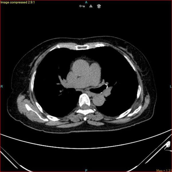 File:Azygos vein aneurysm (Radiopaedia 77824-90130 A 29).jpg