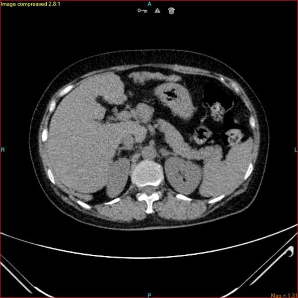 File:Azygos vein aneurysm (Radiopaedia 77824-90130 A 55).jpg