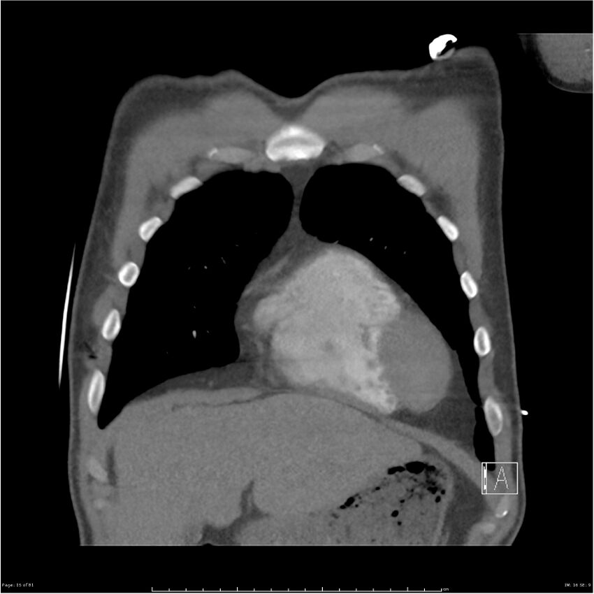 Azygos venous system anatomy (CT pulmonary angiography) (Radiopaedia 25928-26077 Coronal C+ CTPA 15).jpg