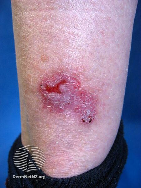 File:Basal cell carcinoma, leg (DermNet NZ bcc-leg-15-dn).jpg