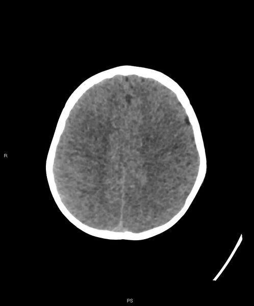 File:Basal ganglia and parenchymal ischemia (Radiopaedia 45818-50083 Axial non-contrast 11).jpg