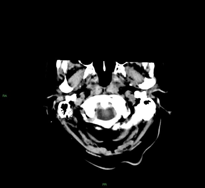 File:Basal ganglia hemorrhage (Radiopaedia 58790-66024 Axial non-contrast 44).jpg