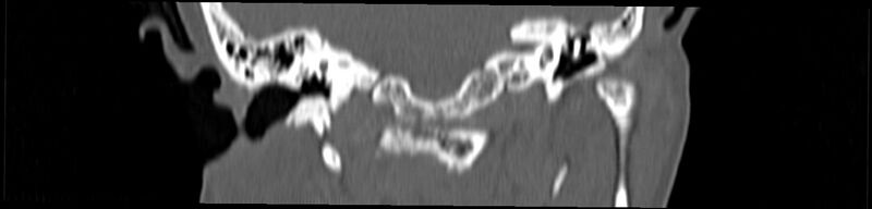 File:Basilar impression (Radiopaedia 52411-58522 Coronal bone window 86).jpg