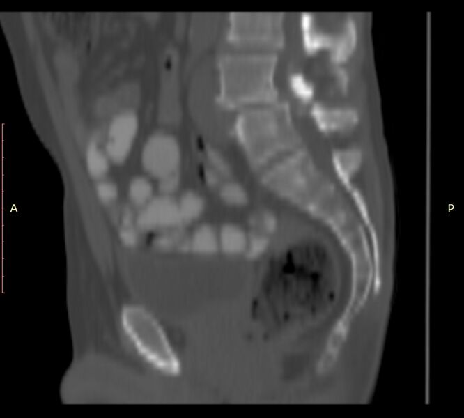 File:Bertolotti syndrome (Radiopaedia 58974-66235 Sagittal bone window 24).jpg