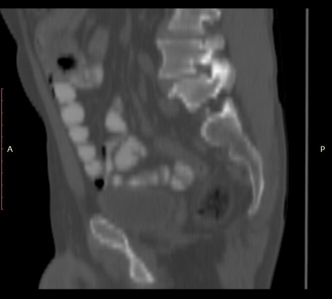 File:Bertolotti syndrome (Radiopaedia 58974-66235 Sagittal bone window 37).jpg