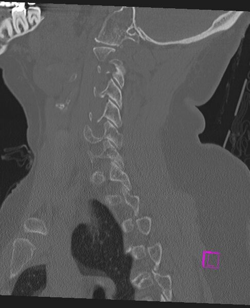 File:Bilateral atlanto-occipital assimilation (Radiopaedia 28350-28603 Sagittal bone window 53).jpg