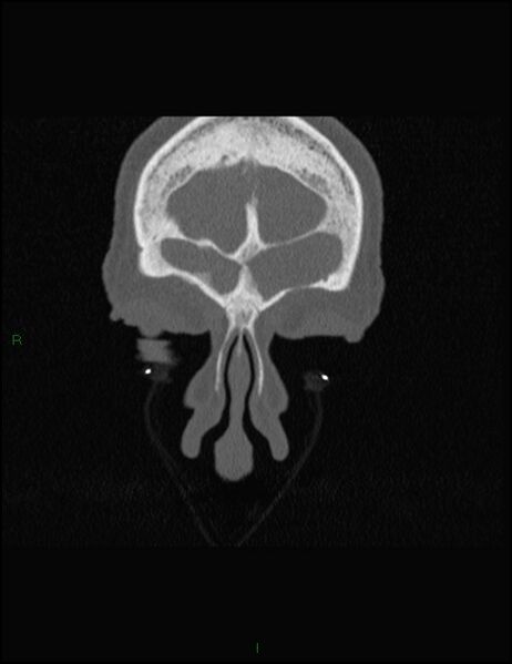 File:Bilateral frontal mucoceles (Radiopaedia 82352-96454 Coronal 55).jpg