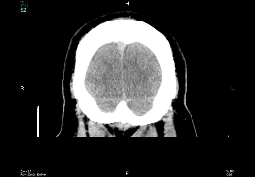 Bilateral medial medullary infarction (Radiopaedia 42220-45295 Coronal non-contrast 52).jpg