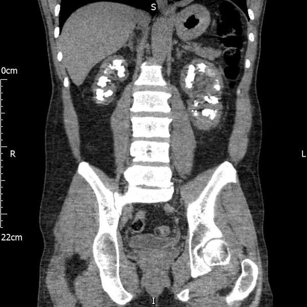 File:Bilateral medullary nephrocalcinosis with ureteric calculi (Radiopaedia 71269-81569 Coronal non-contrast 45).jpg