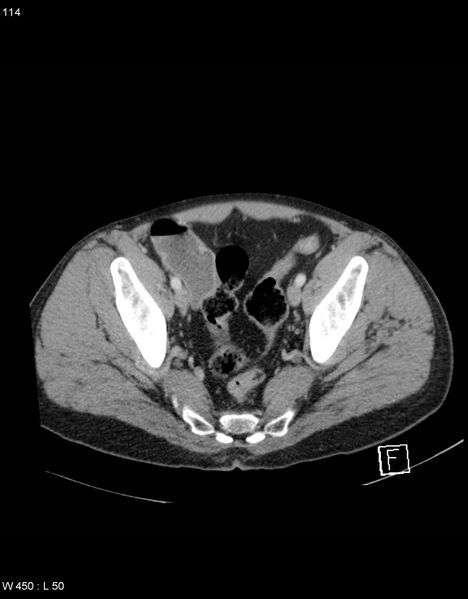 File:Boerhaave syndrome with tension pneumothorax (Radiopaedia 56794-63603 A 57).jpg