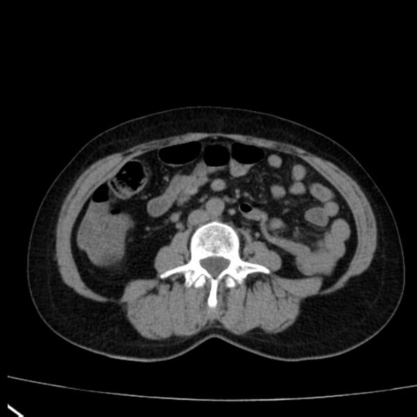 File:Bosniak renal cyst - type I (Radiopaedia 27479-27675 Axial non-contrast 52).jpg