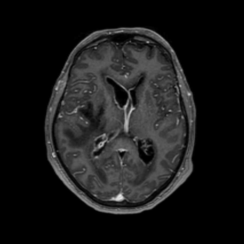 Brain abscess complicated by intraventricular rupture and ventriculitis (Radiopaedia 82434-96577 Axial T1 C+ 36).jpg